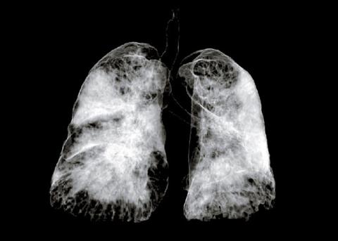 CT-Scan von einer mit Sars-CoV-2 infizierten Lunge